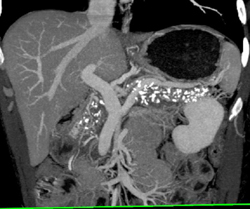 Chronic Pancreatitis - CTisus CT Scan