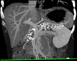 Chronic Pancreatitis - CTisus CT Scan