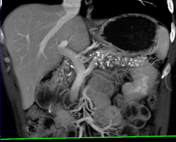 Chronic Pancreatitis - CTisus CT Scan