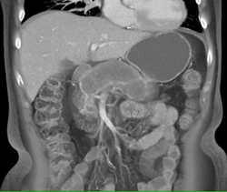 Intraductal Papillary Mucinous Neoplasm (IPMN) Involves the Entire Pancreatic Gland - CTisus CT Scan