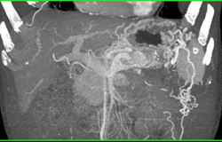 Tumor Occludes Splenic Vein - CTisus CT Scan