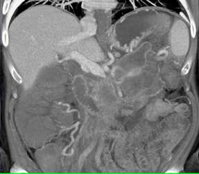 Partial Splenic Vein Thrombosis With Collaterals - CTisus CT Scan