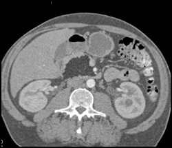 Lipoma of the Pancreas - CTisus CT Scan