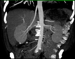 High Origin of Right Renal Artery - CTisus CT Scan