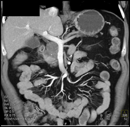 Adenocarcinoma Arises in An Intraductal Papillary Mucinous Neoplasm (IPMN) - CTisus CT Scan