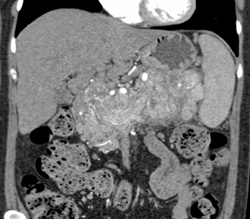 Diffuse Infiltration of the Pancreas By An Islet Cell Tumor - CTisus CT Scan