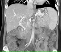 Extensive Collaterals Due to Venous Occlusion - CTisus CT Scan