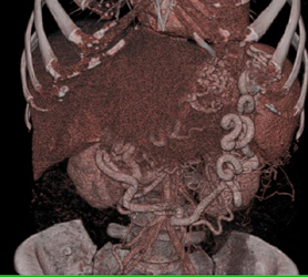 Islet Cell Tumor Invades Portal Vein and Splenic Vein With Extensive Collaterals - CTisus CT Scan