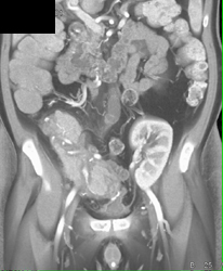 Pancreatitis in A Patient With A Pancreas and Renal Transplant - CTisus CT Scan