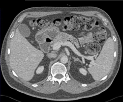 Pancreatic Cancer With Dilated Pancreatic Duct - CTisus CT Scan