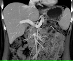 Encasement of PV/SMV Confluence By Pancreatic Cancer - CTisus CT Scan