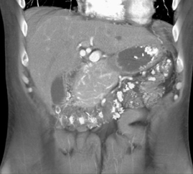 Islet Cell Tumor - CTisus CT Scan