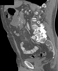 Encasement of PV/SMV Confuence By Pancreatic Cancer - CTisus CT Scan