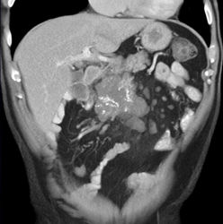 Islet Cell Tumor With Liver Metastases With Liver Metastases - CTisus CT Scan