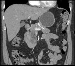 Focal Fat in Pancreatic Head - CTisus CT Scan