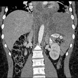 Pancreatitis Extends Into the Posterior Mediastinum - CTisus CT Scan