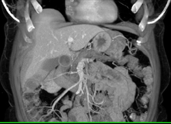 Pancreatic Carcinoma in the Body of the Pancreas - CTisus CT Scan