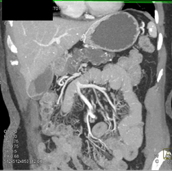 Intraductal Papillary Mucinous Neoplasm (IPMN) Replaces the Entire Pancreas Looking Like A Huge Pancreatic Duct - CTisus CT Scan