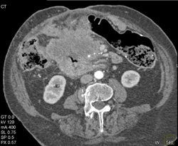 GIST Tumor Simulates A Pancreatic Mass - CTisus CT Scan