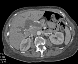 Huge Common Bile Duct (CBD) With Obstruction - CTisus CT Scan