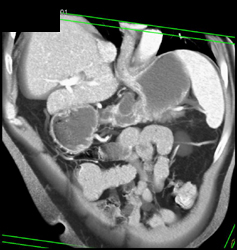 Intraductal Papillary Mucinous Neoplasm (IPMN) - CTisus CT Scan