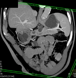 Intraductal Papillary Mucinous Neoplasm (IPMN) - CTisus CT Scan