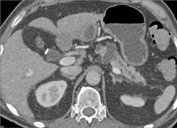 Intraductal Papillary Mucinous Neoplasm (IPMN) - CTisus CT Scan