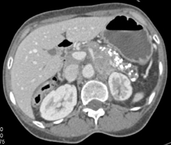 Chronic Pancreatitis and Pancreatic Cancer Encases Celiac Artery - CTisus CT Scan