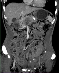 Pancreatic Cancer Encases PV/SMV - CTisus CT Scan