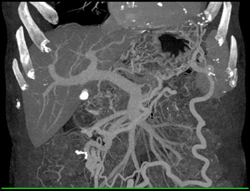 Carcinoma of the Pancreatic Tail Occludes the Splenic Vein - CTisus CT Scan