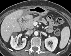 Intraductal Papillary Mucinous Neoplasm (IPMN) - CTisus CT Scan