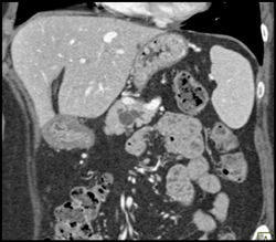 Intraductal Papillary Mucinous Neoplasm (IPMN) - CTisus CT Scan