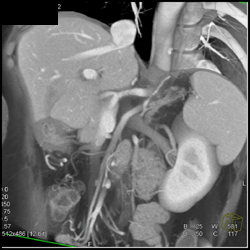 Intraductal Papillary Mucinous Neoplasm (IPMN) - CTisus CT Scan