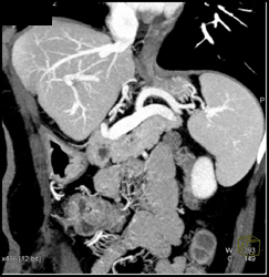 Intraductal Papillary Mucinous Neoplasm (IPMN) - CTisus CT Scan