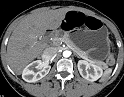 Intraductal Papillary Mucinous Neoplasm (IPMN) - CTisus CT Scan