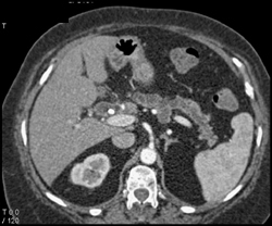 Dilated Pancreatic Duct and Intraductal Papillary Mucinous Neoplasm (IPMN) - CTisus CT Scan