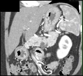 Intraductal Papillary Mucinous Neoplasm (IPMN) - CTisus CT Scan