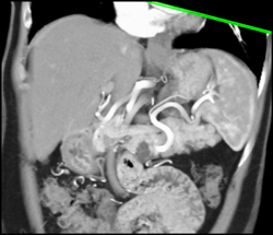 Intraductal Papillary Mucinous Neoplasm (IPMN) - CTisus CT Scan