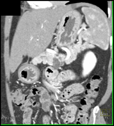 Intraductal Papillary Mucinous Neoplasm (IPMN) - CTisus CT Scan