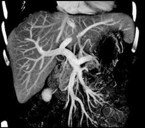 Intraductal Papillary Mucinous Neoplasm (IPMN) of the Body of the Pancreas Seen in Several Views - CTisus CT Scan