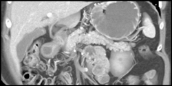 Few Small Intraductal Papillary Mucinous Neoplasms (IPMNs) - CTisus CT Scan