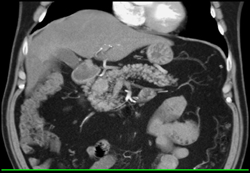 Islet Cell Tumorof the Pancreas - CTisus CT Scan