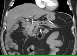 Islet Cell Tumor of the Head of the Pancreas - CTisus CT Scan