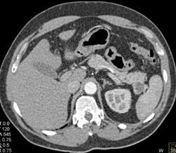 Intraductal Papillary Mucinous Neoplasm (IPMN) of the Tail of the Pancreas Seen With Multiple Renderings - CTisus CT Scan