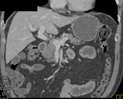 Focal Fat in Head of Pancreas - CTisus CT Scan