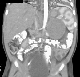 Neurogenic Tumor Near the Pancreatic Tail - CTisus CT Scan