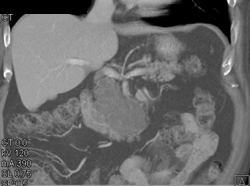 Cystadenoma - CTisus CT Scan