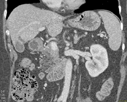 Insulinoma - CTisus CT Scan