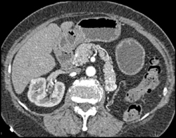 Metastatic Renal Cell Carcinoma to the Tail of the Pancreas - CTisus CT Scan