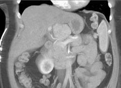 Castleman Disease Simulates A Pancreatic Mass - CTisus CT Scan